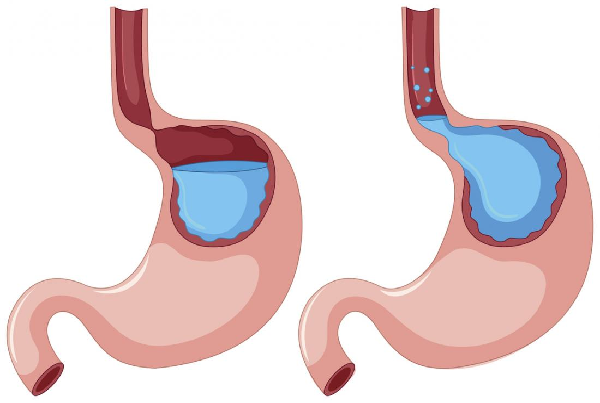 Reflux Disease