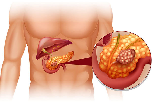 Pancreatitis