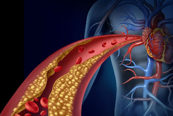 Dyslipidemia